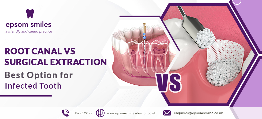 Root Canal Vs. Surgical Extraction - Best Option for Infected Tooth