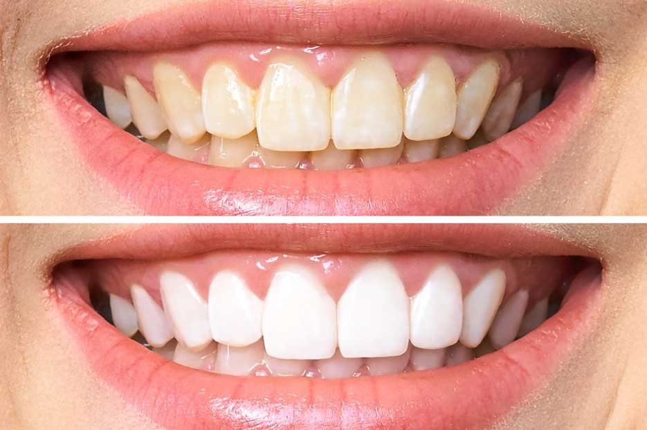 Enlighten-Teeth-Whitening-Before-and-After-Example