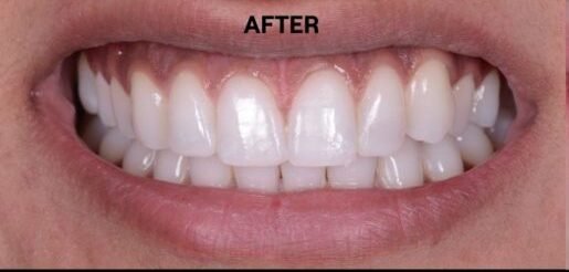 after whitening with epsom