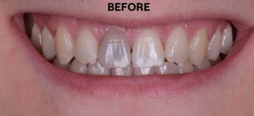 before whitening with epsom