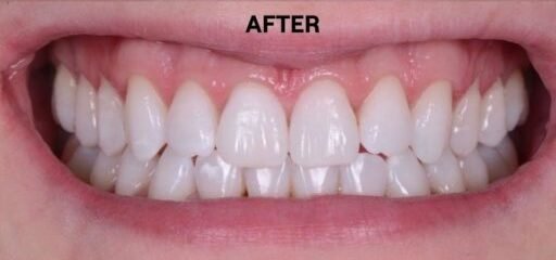 after whitening with epsom