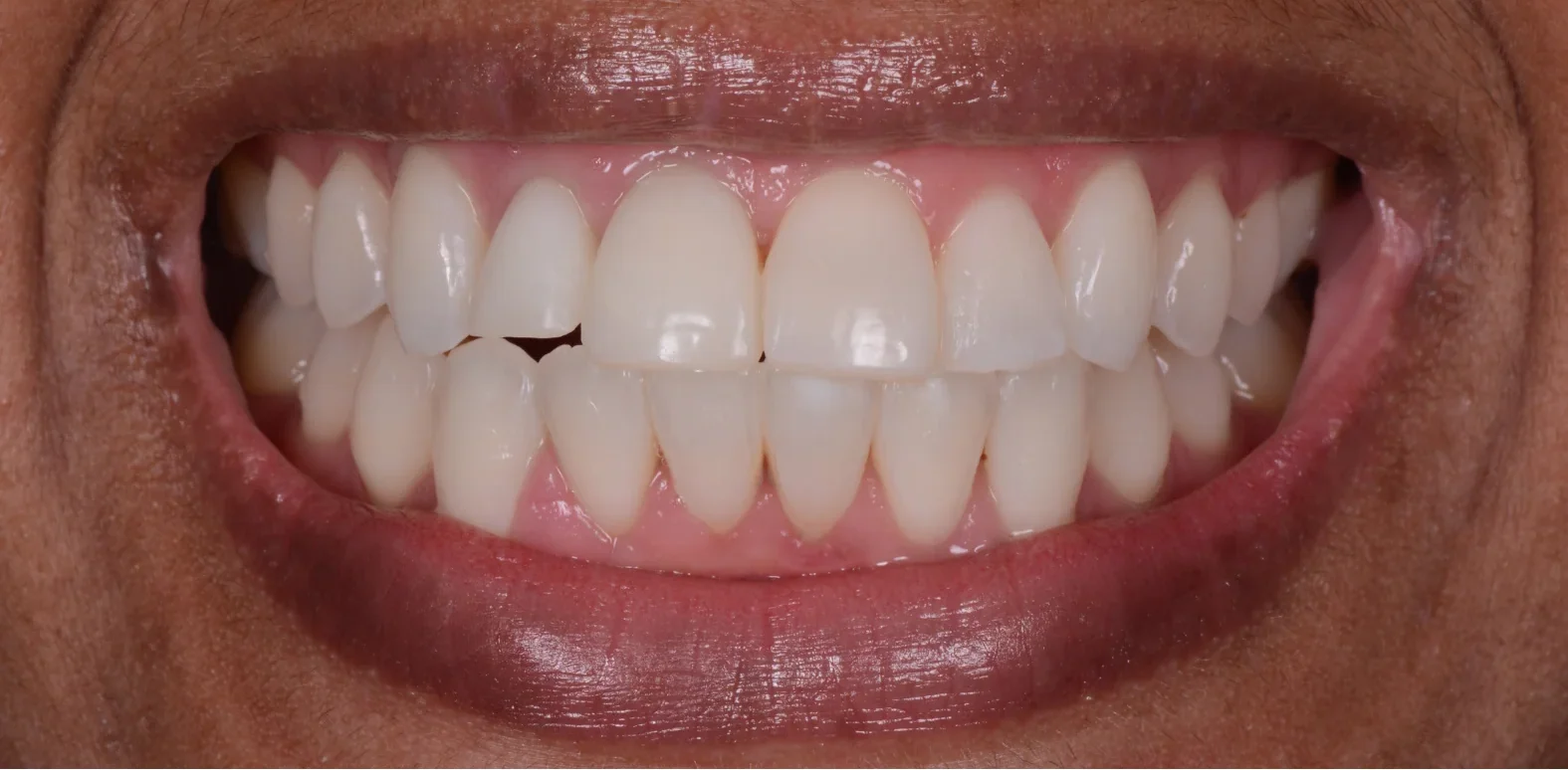 after epsom tooth whitening