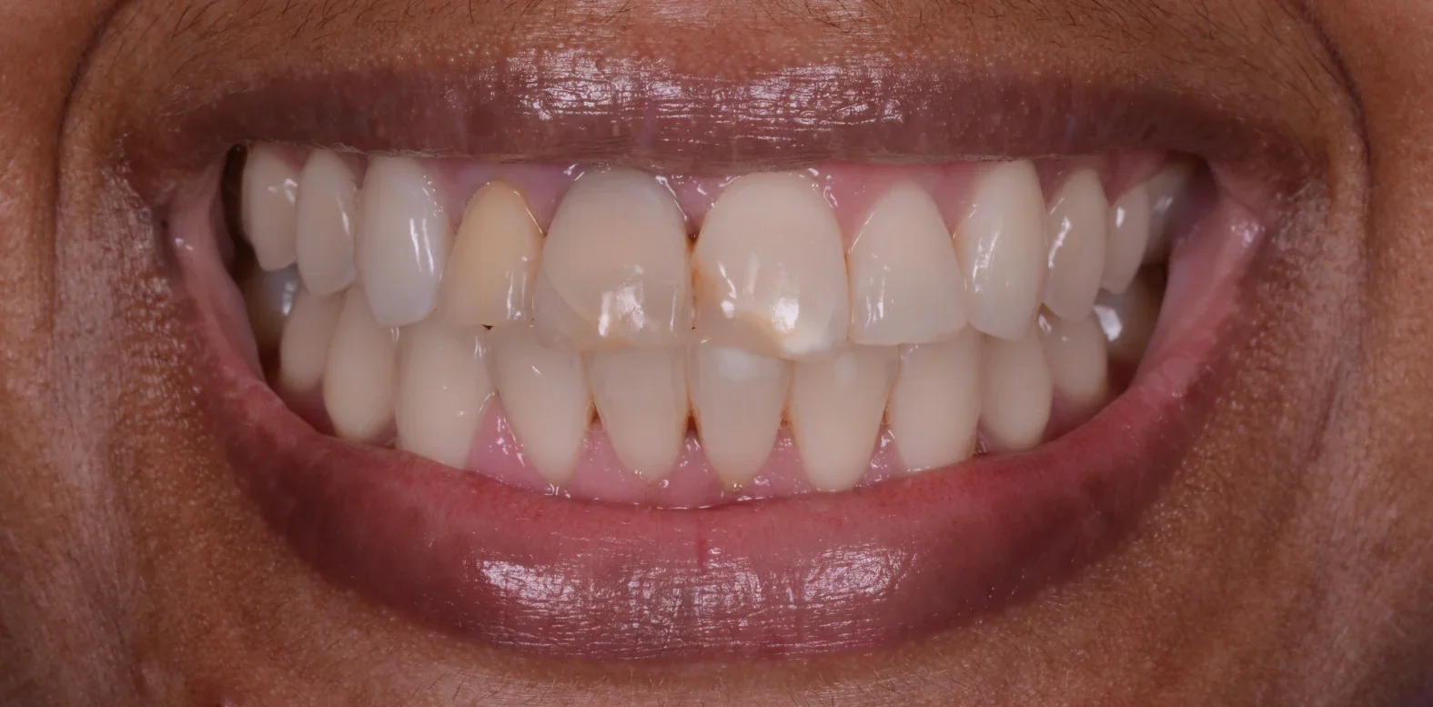 before epsom tooth whitening