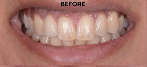 before whitening with epsom